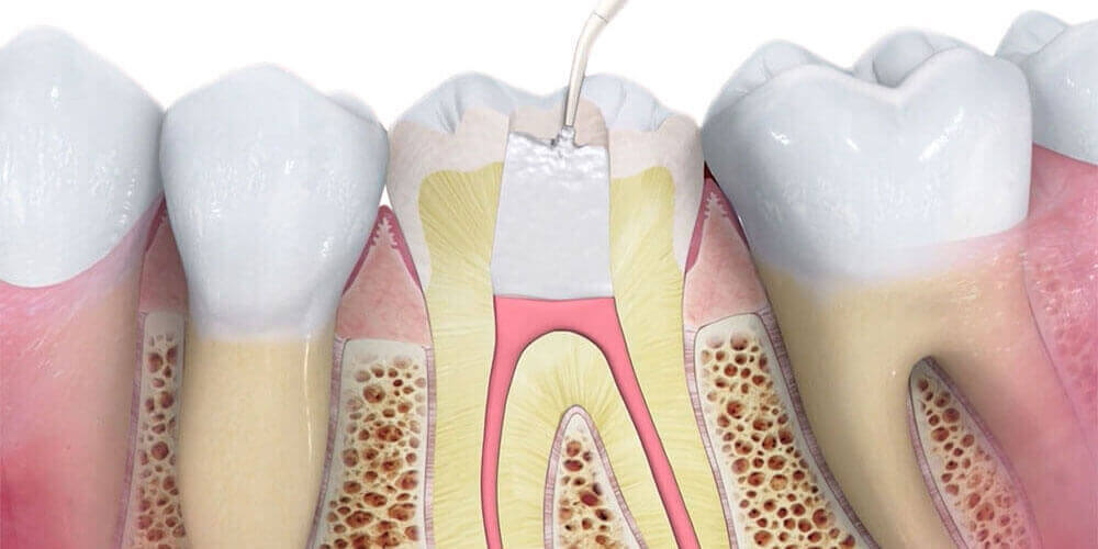 root canal